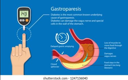 Diabetic gastroparesis